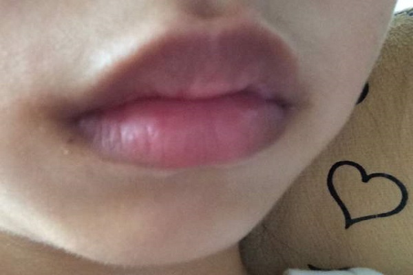 为什么有的女性嘴唇边很黑？