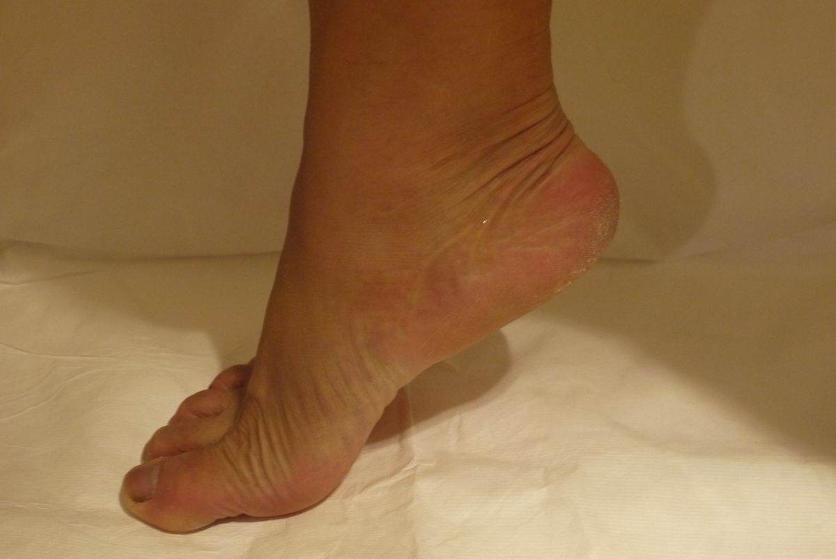 筋膜炎怎样治？